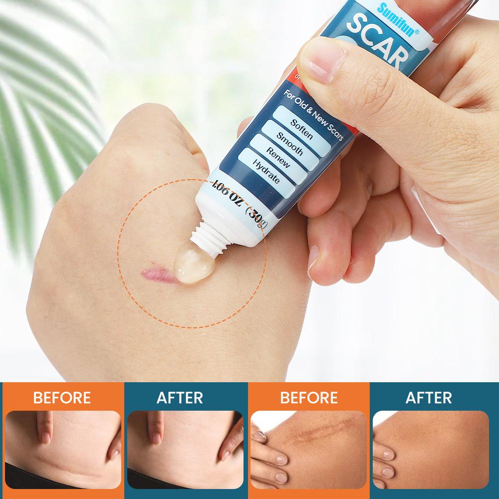 Pastă delicată pentru îndepărtarea cicatricilor și tratează arsurile, repararea cicatricilor, diminuarea gelului pentru cicatrici, pastă pentru reducerea cicatricilor pentru toate tipurile de piele