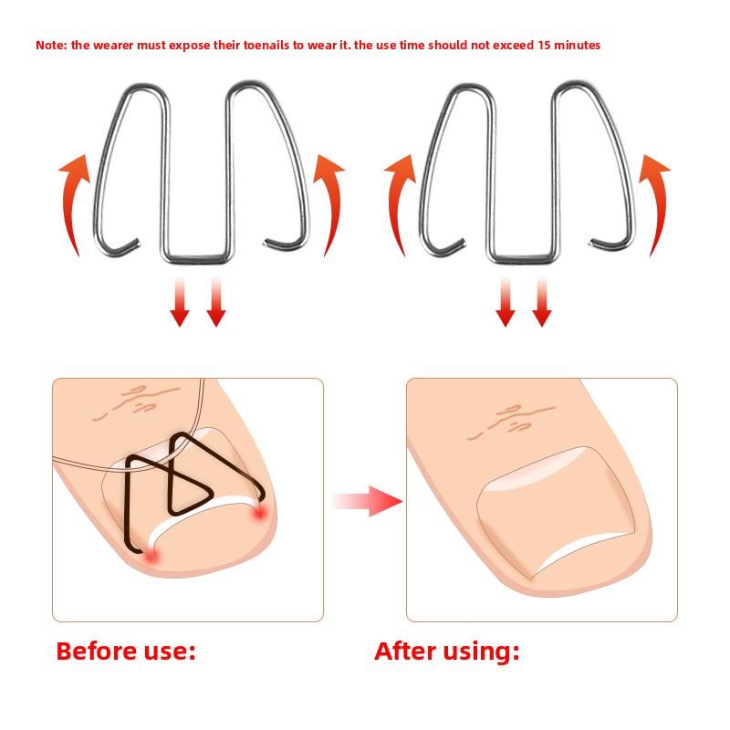 Nagelkorrekturdraht, Gerät zur Korrektur eingewachsener Nägel, Nagelschneiden, Korrekturdraht für eingewachsene Nägel, Zehennagelkorrekturhaken