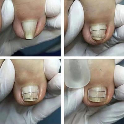 Herramientas correctoras para uñas encarnadas, pedicura, recuperación, tratamiento para uñas encarnadas, pinza profesional para enderezar uñas encarnadas