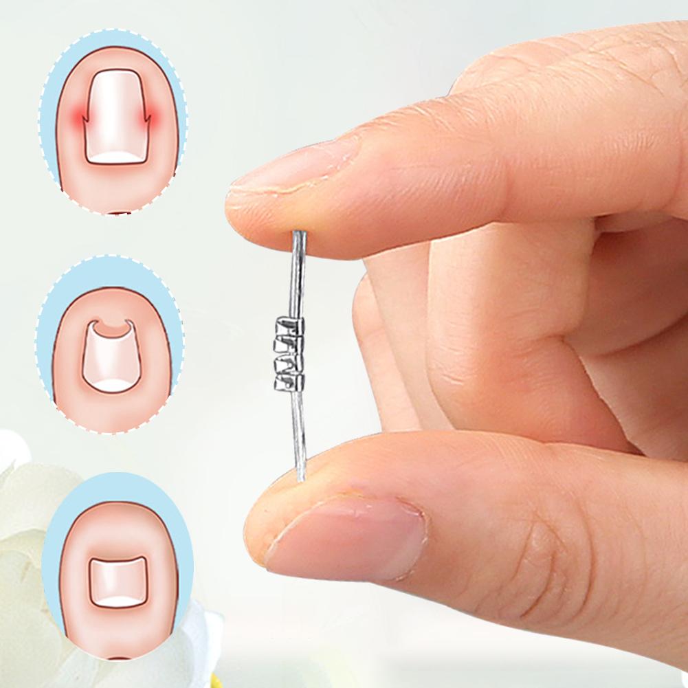 Ingrown Toenail Pedicure Tool Embed Toe Nail Care Straightening Correction Clip Curved Clamp Toenails Correction Tool for Toes
