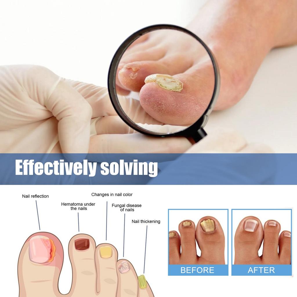 Tånagelsvampsplåster, Nattnagelvårdsplåster, Snabba nagelvårdsplåster, Minska Onychomycosis Och Mjuka Naglar (32 st/kartong) 2 st