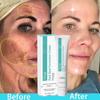 Creme Potente Clareador de Sardas Remove Melasma Manchas Escuras Clareia Pigmentação Acne Hidratante Ilumina Cuidados com a Pele