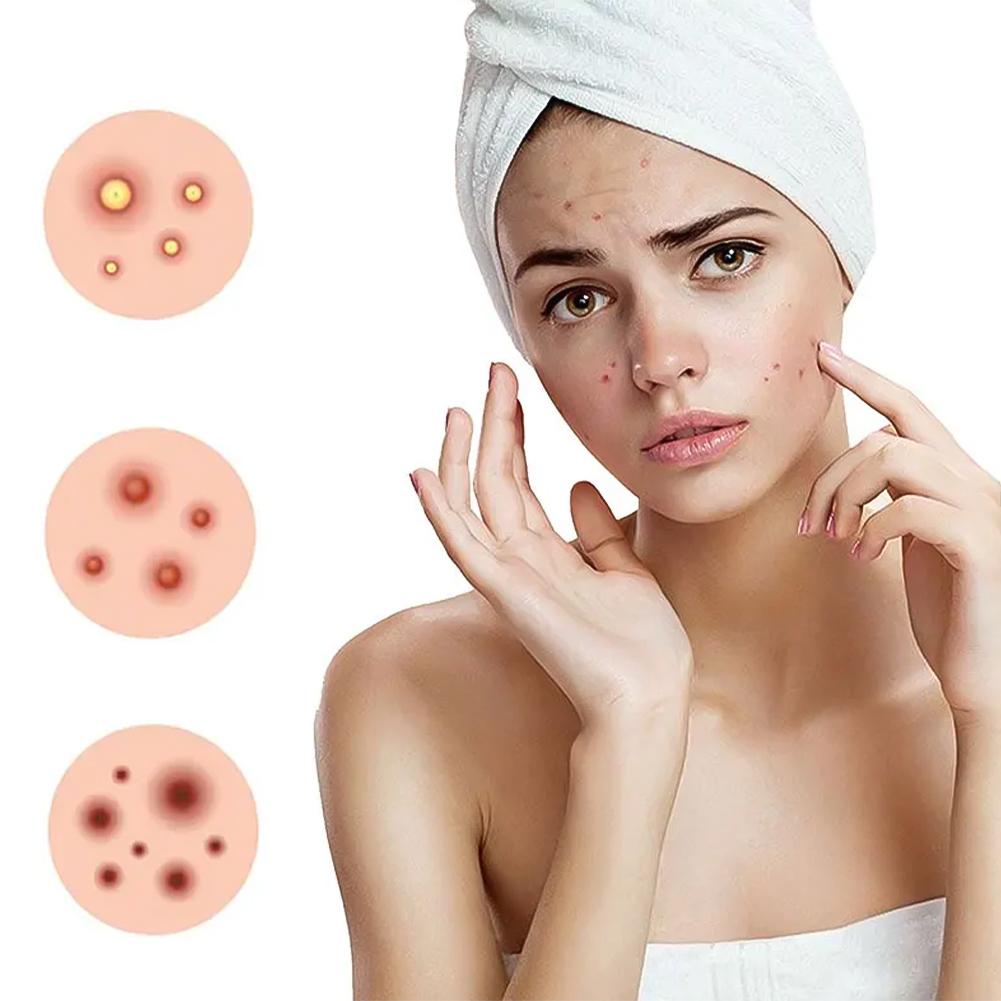 200Pcs Acne Patches Fade Blemishes Pimple Marks Closed Acne Blemishes Hydrocolloid Star Heart Shaped Cover Acne Pimple Patch