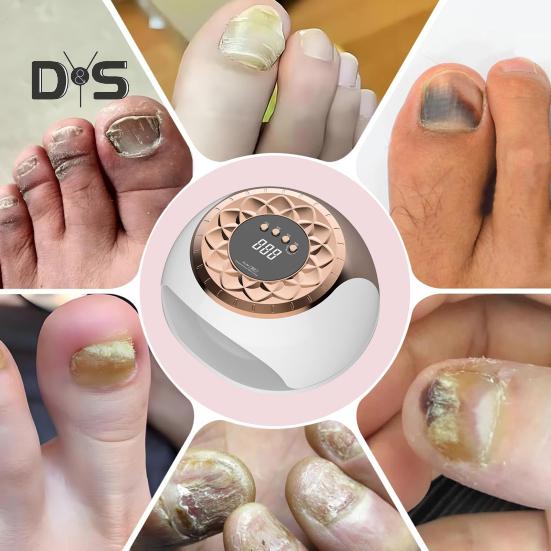 UV LED Nagel Lamp Nagel Schimmel Behandeling Apparaat 650nm Infrarood Licht 470nm Blauw Licht Teennagel Vingernagel Onychomycose Verwijdering Gel Polish Drogen