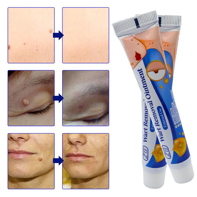 ZB Mole Removal Ointment Skin Care Mild Ingredients Collagen Daily Skin Care
