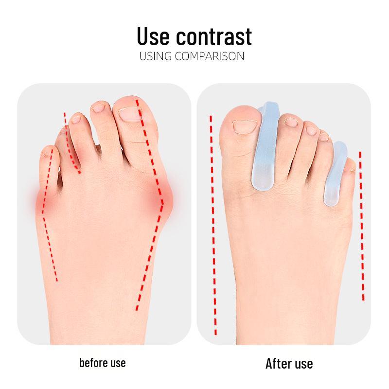 A-shaped Toe Valgus Corrector & Separator for Little Toe