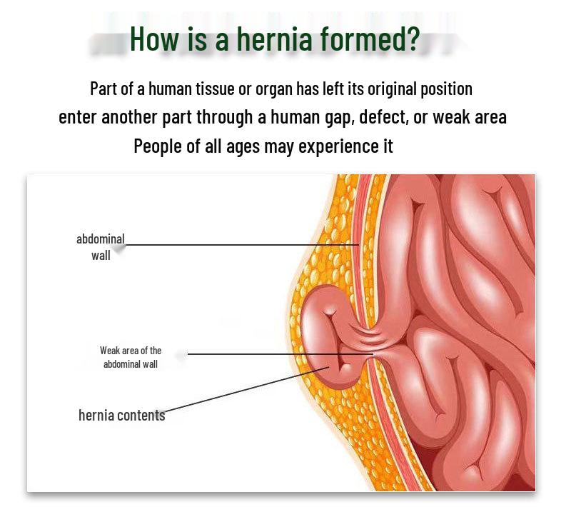 Double-Sided Inguinal Hernia Belt for Adults - Oblique Support and Small Intestine Protection