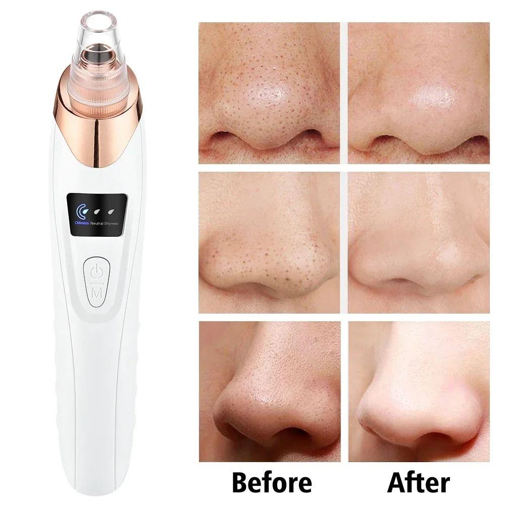 3 Suction Mode Vacuum Pore Cleaner 5 Suction Heads Blackhead Suction Device  Spot Acne