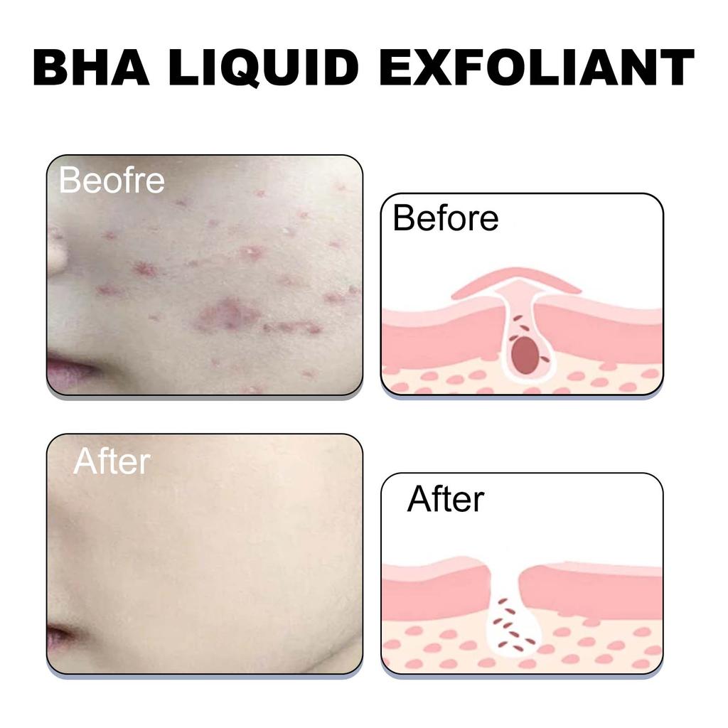 Hoygi Salicylic Acid Acne Clear Serum, Improves Acne, Fades Acne Marks, Tightens Pores, and Moisturizes the Skin. Suitable for the Face, 118ml