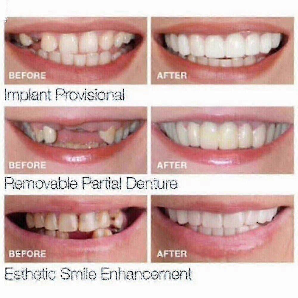 Smile Snap On False Teeth Upper Lower Dental Veneers Dentures Tooth Cover Set