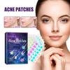 Eelhoe Pimple Patches For Effective Skin Repair And Acne Spot Treatment With 180 Pieces For Clear Complexion