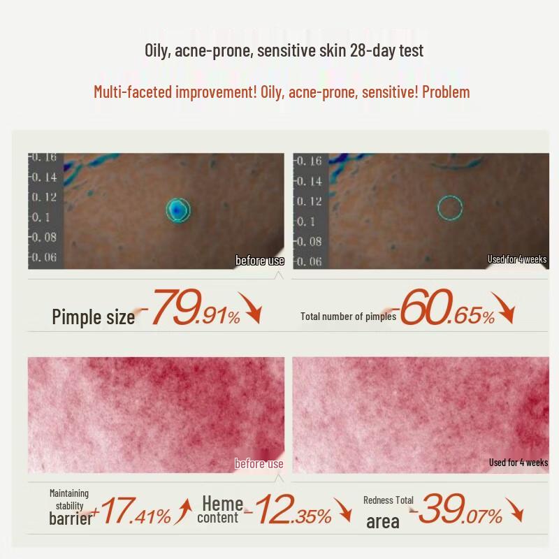 HBN Pore-Refining Acne Control Serum