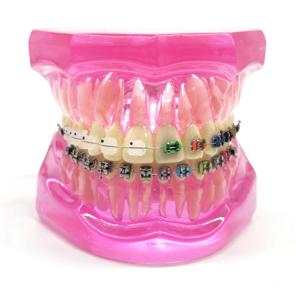 Dental Orthodontic Teeth Tooth Model 4 Kinds Brackets Ceramic and Metal Brackets for Patient Communication Dental Study Model