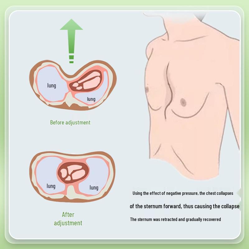 Korektor pectus excavatum střední hmotnosti s podtlakem pro korekci vkleslé hrudi a zlomeniny hrudní kosti