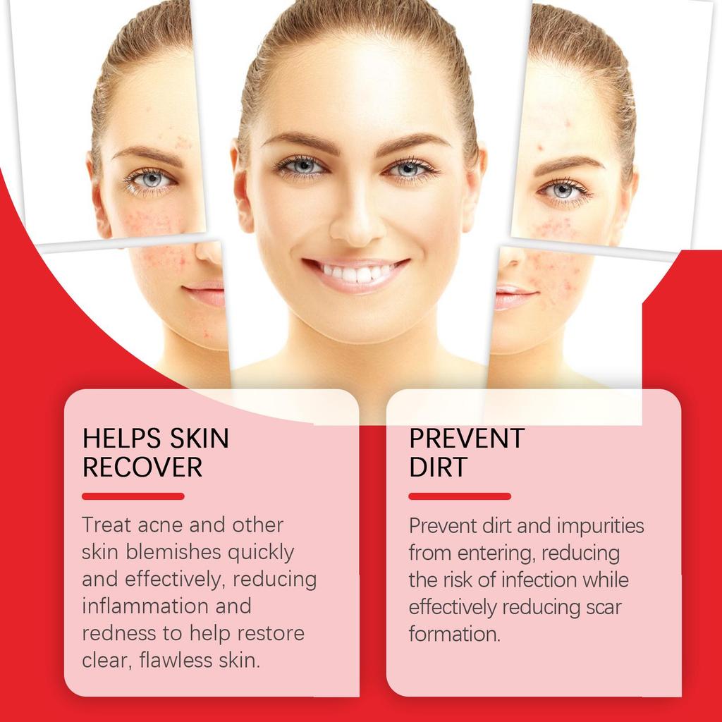 Jaysuing Acne Patches: Top-quality Hydrogel Acne Patches Designed Specifically To Reduce Acne and Whiteheads, 200 Pieces.