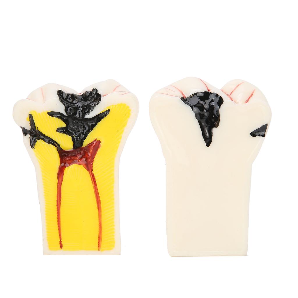 Dental Caries Model Tooth Decay Demonstration Model Simulation Detachable Teeth Model