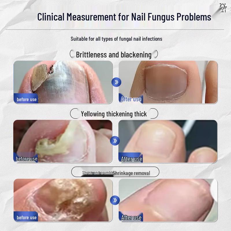 Nail Fungus Repair Solution