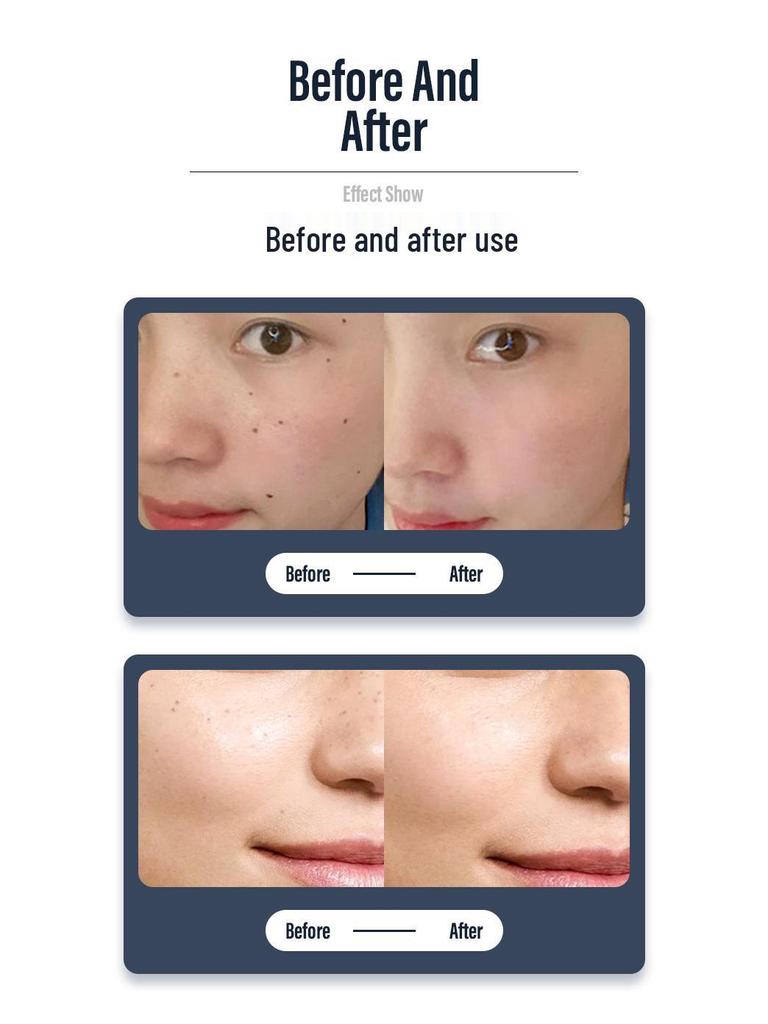 Handheld Mole and Spot Removal Pen for Beauty Salons