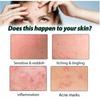 Azelaic Acid Acne Gel Cream 20g Oil Control Repair Dark Spot Fade Gentle Face Care