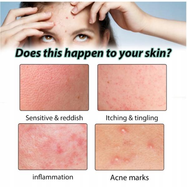Azelaic Acid Acne Gel Cream 20g Oil Control Repair Dark Spot Fade Gentle Face Care