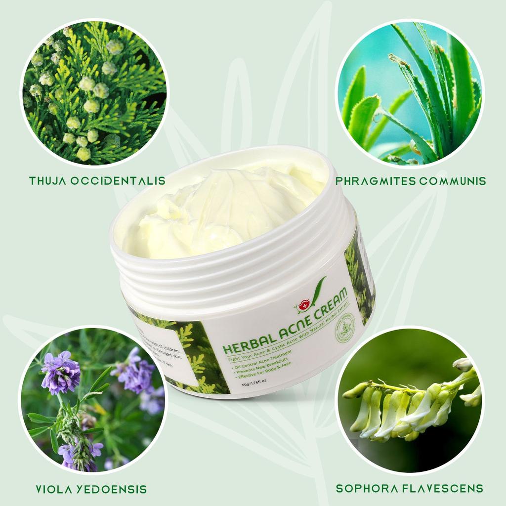 Herbal Acne Creams Anti-Pimple Creams Anti-Acne Creams Acne Balance Water And Oil Skin Blemishes Effective For Body And Face 50g