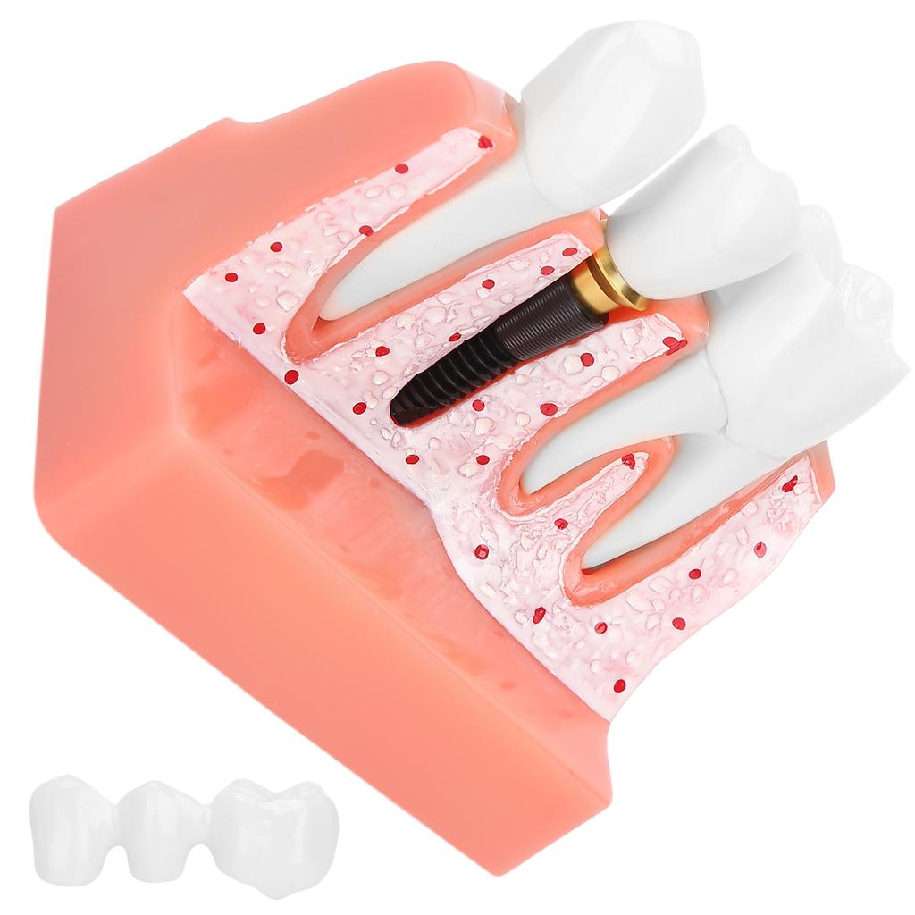 Model zubů Analýza zubního implantátu Demonstrační model korunkového můstku Model zubu