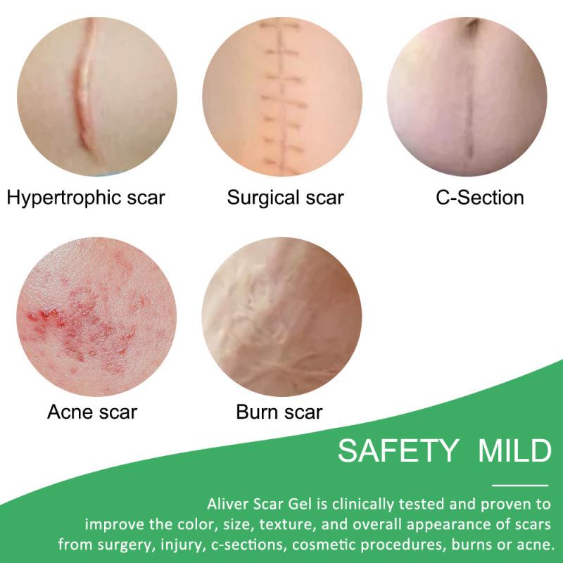 4 Sheets Scar Removal Patch Reusable Silicone Therapy Scar Repair Patch Long-lasting Sticker