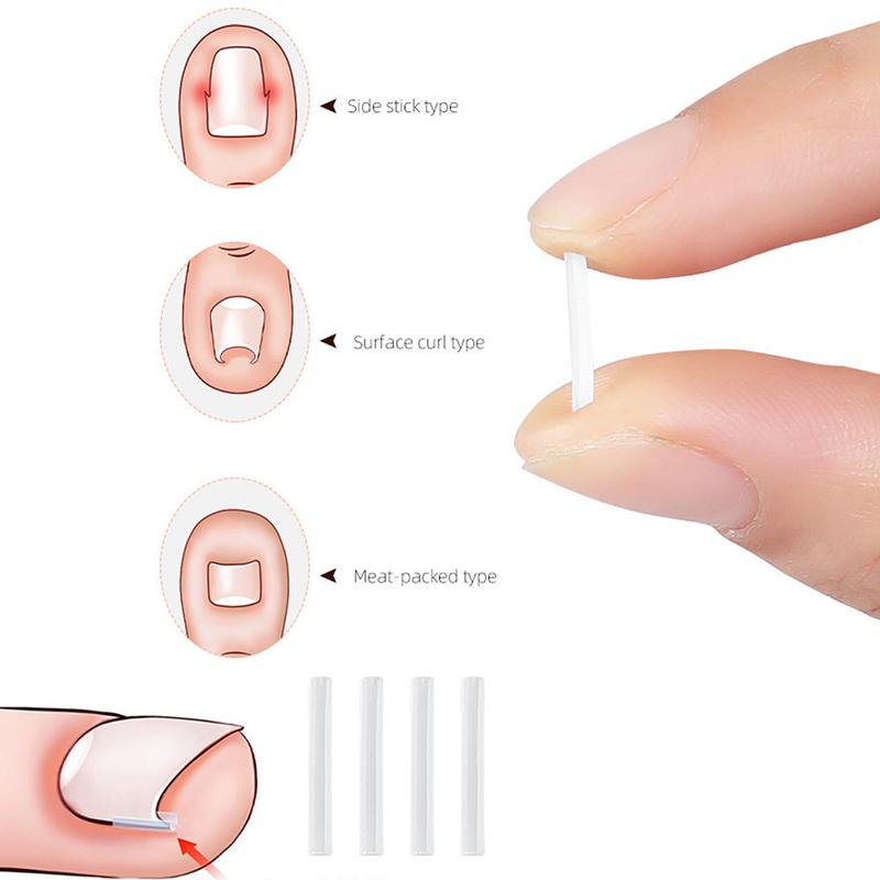 10 Uds. Clip para alisar las uñas de los pies encarnadas, corrección de uñas, parche adhesivo