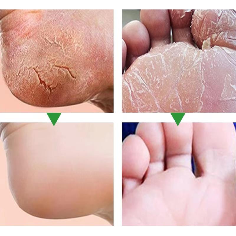 Herbal Anti Crack Foot Cream Heel Cracking Repair Products Exfoliation Dead Skin Removal Softening Moisturize Smooth Skin Care