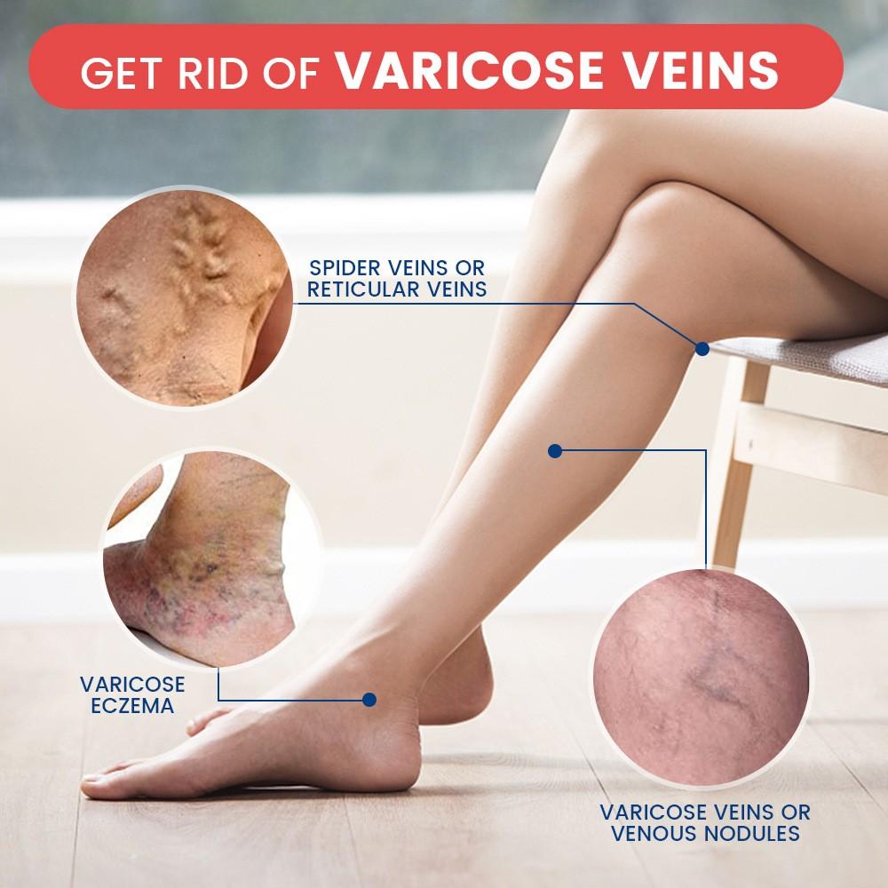 Venous Care Spray Reduces Vascular Protrusions and Smooths Out Varicose Veins the Legs and Throughout the Body.