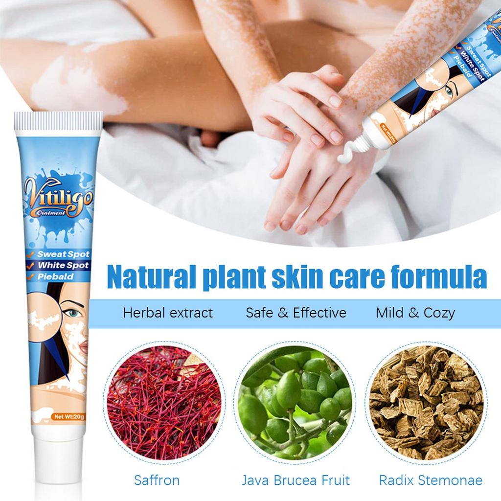 Vitiligo-Creme, natürliche Vitiligo-Linderung der Haut, Vitiligo-Pflegecreme, reduziert weiße Flecken, verbessert die Hautpigmentierung