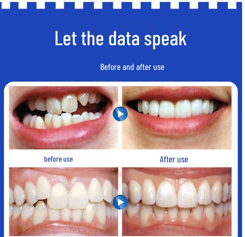 Osynliga Transparenta Ortodontiska Aligners för Tandreglering - 2025 Modell