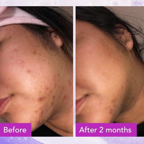 Niacinamid Essenz Serum: Glättet, Spendet Feuchtigkeit und Mildert Dunkle Flecken