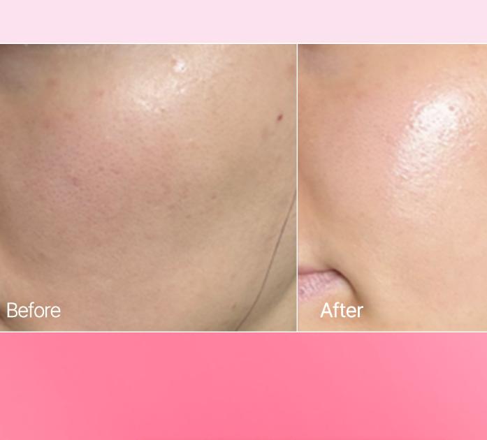 Aprilskin Tranexamic Acid Spicule Ampoule 30ml – Brightening & Spot Care