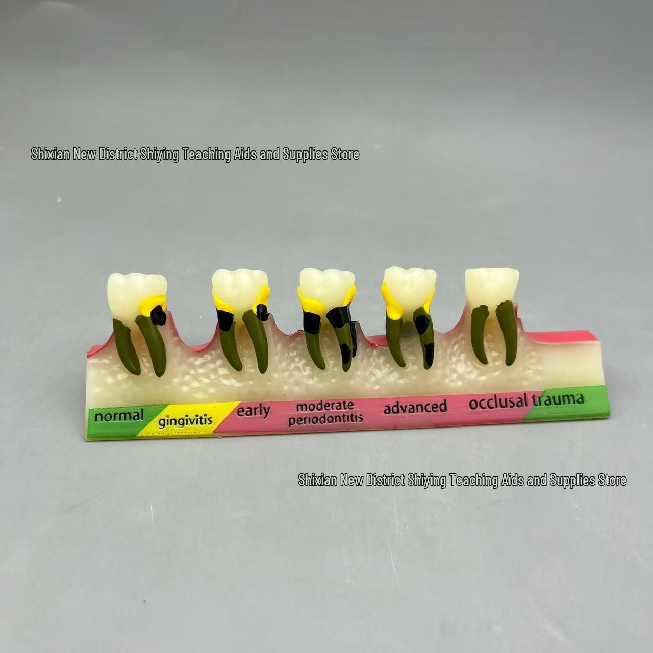 Dental Caries & Repair Teaching Model: Oral Pathology & Periodontal Classification