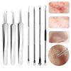Blackhead Remover Tweezers Set Stainless Steel Acne Clip Kit with Anti-slip Handle Popper Tool Easy To Carry Blackhead Extractor Skin Care Tools