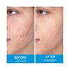 (20g) Brightening Cream Acne, Acne, Scar Skin Care Cream