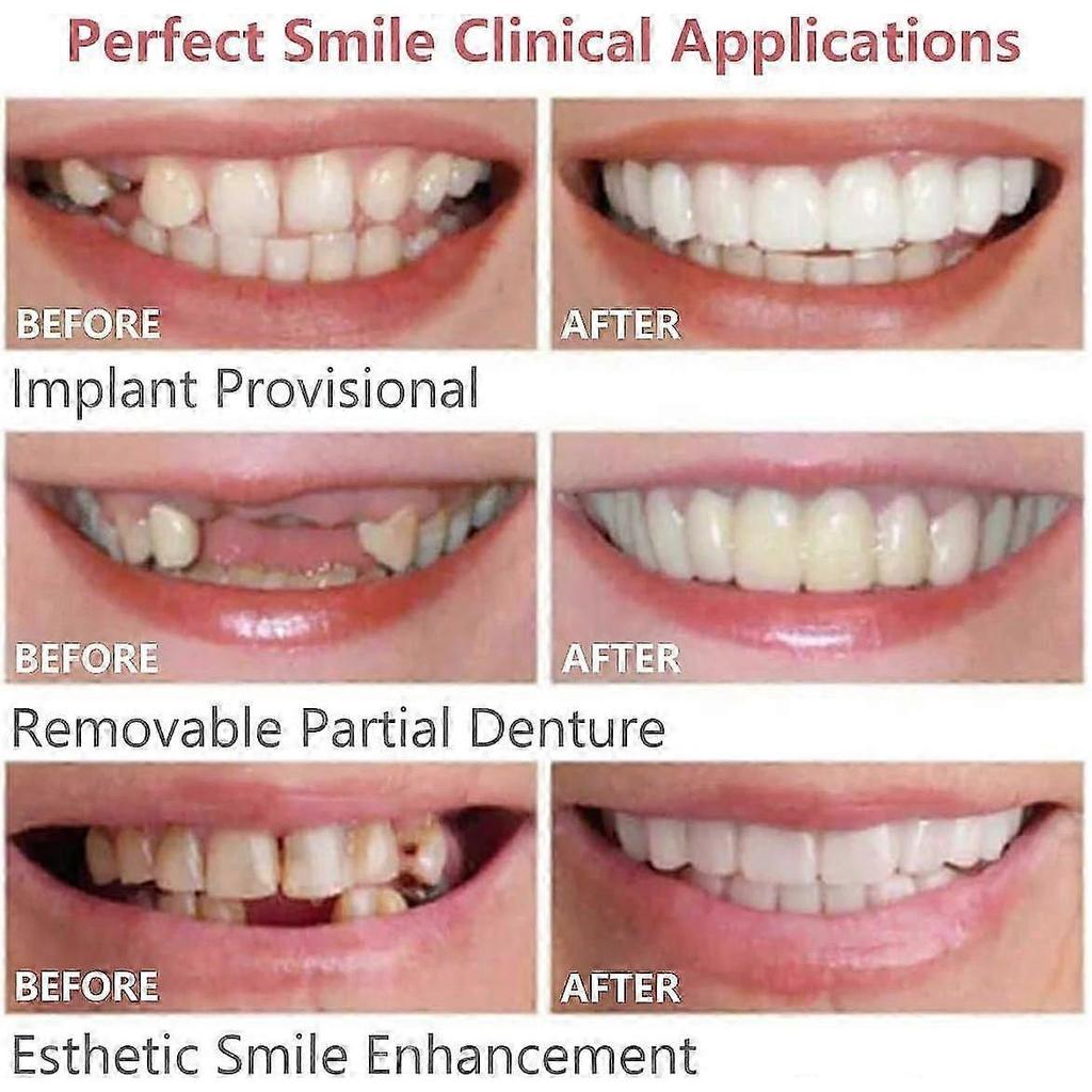 Veneers Fake Teeth for Missing Teeth Instant Smile Whitening Cosmetic Tooth Cover Set