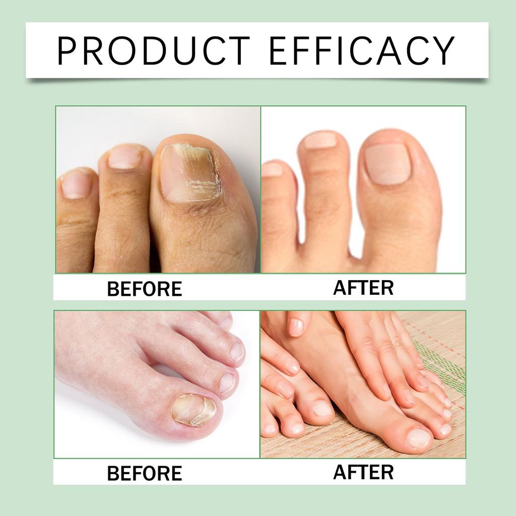 Nail Care Liquid Strengthens Nails , Reduces Cracking And Thickening. It Is A Suitable Nail Liquid For Athletes ,30ml ,