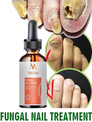 Spray riparatore per unghie fungine Trattamento infermieristico Rimozione funghi unghie piedi Gel anti-infettivo Paronichia Cura onicomicosi