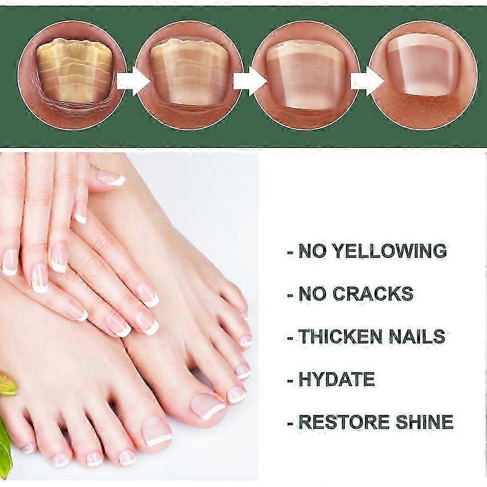 Extrem starke Nagelpilzbehandlung, beste Nagelreparatur Stoppt Pilzwachstum Effektiv