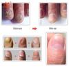 Herbal Nail Treatment Essential Oil Hand and Foot Whitening Toe Nail Removal Feet Care Polish Nail Gel Nail Repair Treatment