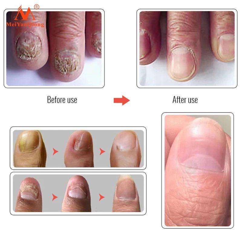 Herbal Nail Treatment Essential Oil Hand and Foot Whitening Toe Nail Removal Feet Care Polish Nail Gel Nail Repair Treatment