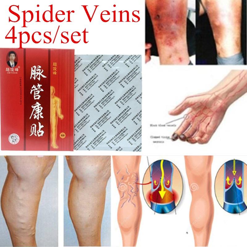 

4шт/набор No Box паук вен Варикозное расширение лечения штукатурка Cure патч природных решение Травяные Патчи