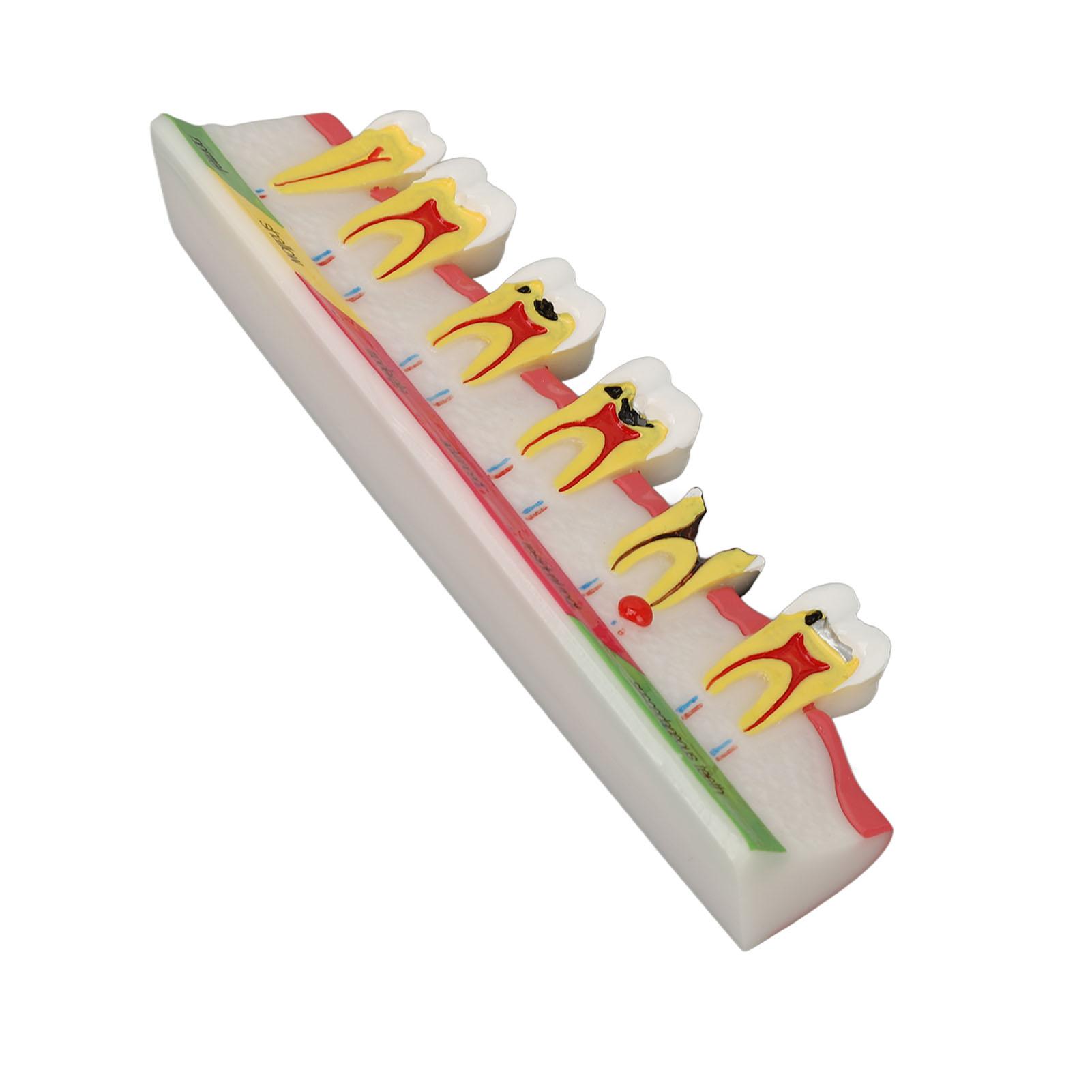 

Dental Caries Model 6 Different Stages Resin Decayed Tooth Display Model