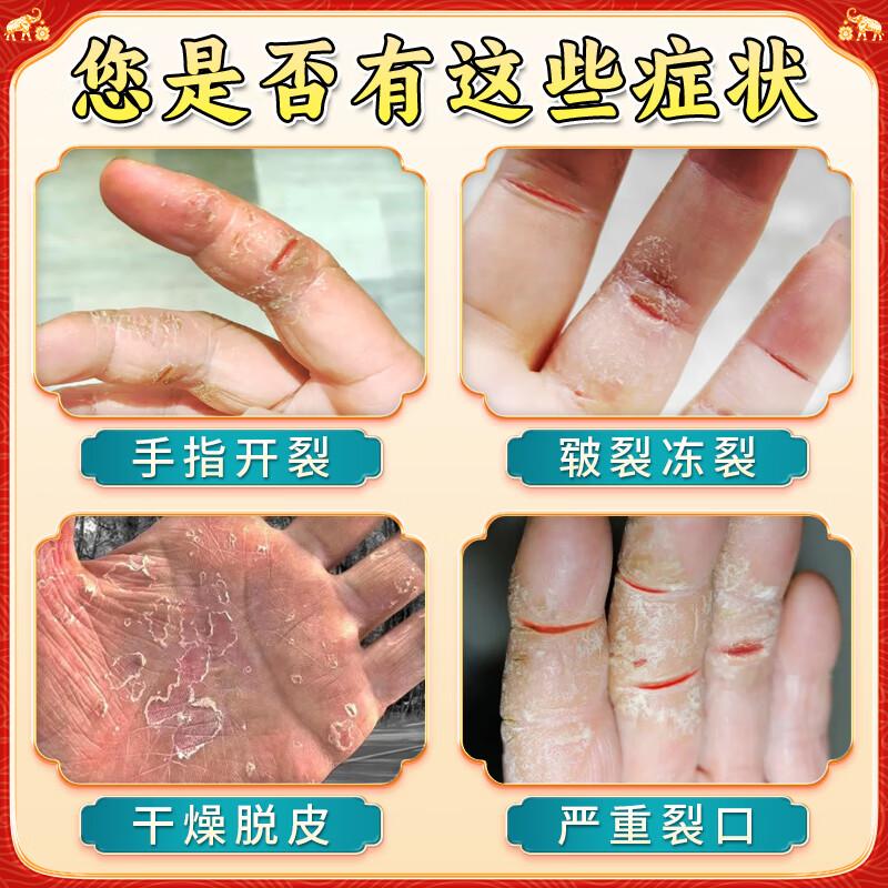 Thai Hand & Foot Crack Balm - Soothes Chapped Skin, 55g Imported Repair Cream