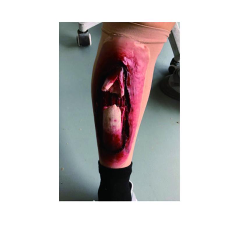 AWR Набор для первой помощи при переломе голени