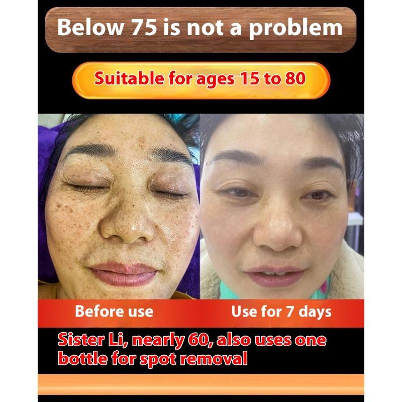 Whitening and Freckle Removing Cream Face Cream Lightening and Removing Spotles Sunburn Brightening Skin Color