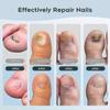 Portable Nail Fungus Laser Treatment Device - 905nm Infrared & 470nm Blue Dual Light Therapy for Toenails Fingernails