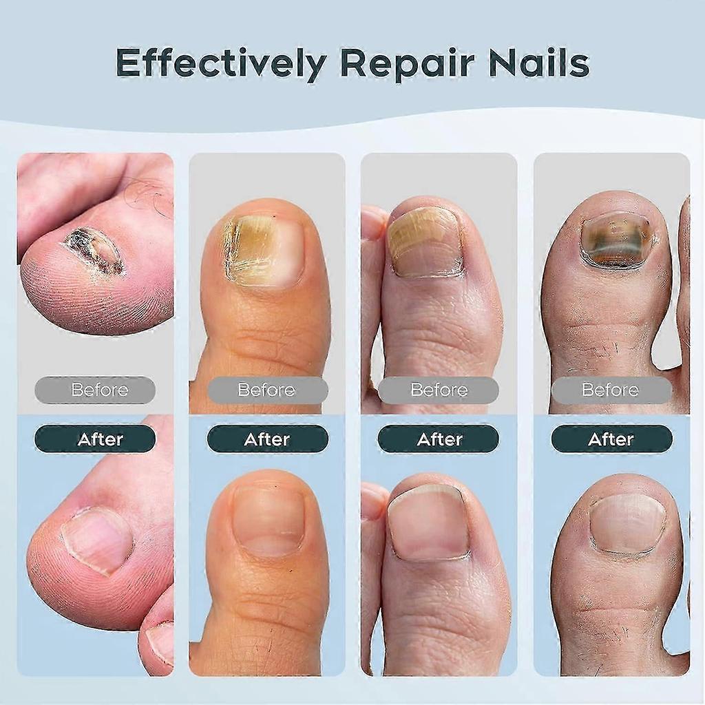 Portable Nail Fungus Laser Treatment Device - 905nm Infrared & 470nm Blue Dual Light Therapy for Toenails Fingernails